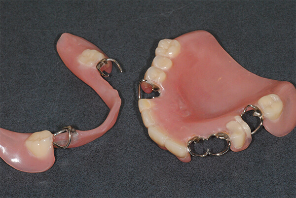 レジン床部分義歯