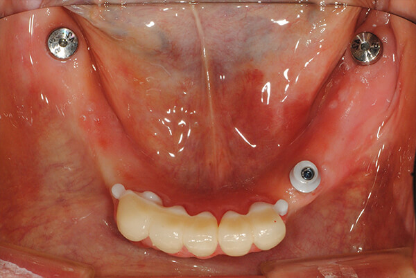 特殊金属床部分義歯+インプラント