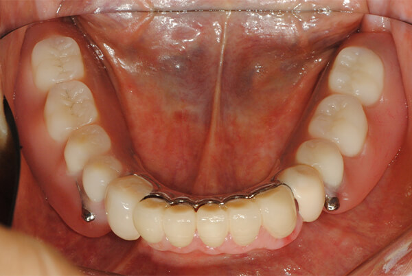 特殊金属床部分義歯+インプラント