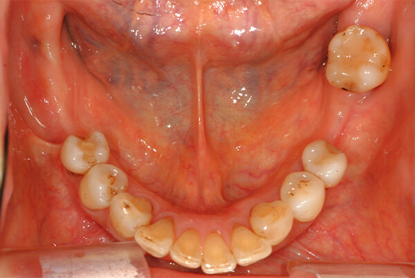 特殊金属床部分義歯（2次性連結固定）