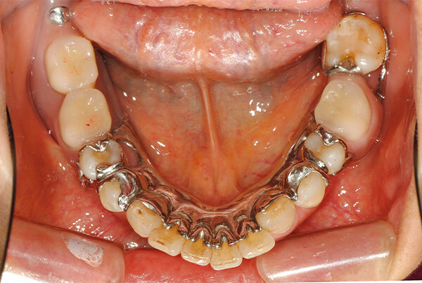 特殊金属床部分義歯（2次性連結固定）