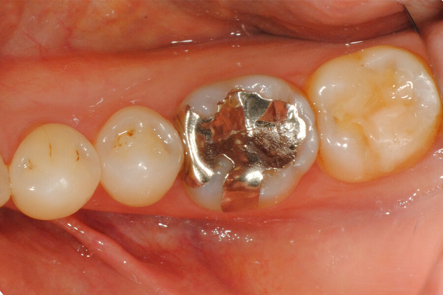 臼歯部インレーの再修復