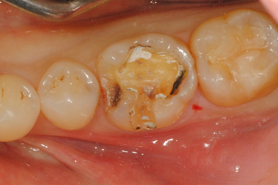 臼歯部インレーの再修復
