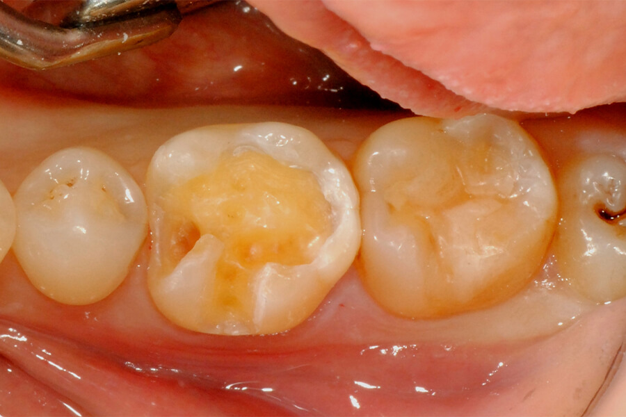 臼歯部インレーの再修復