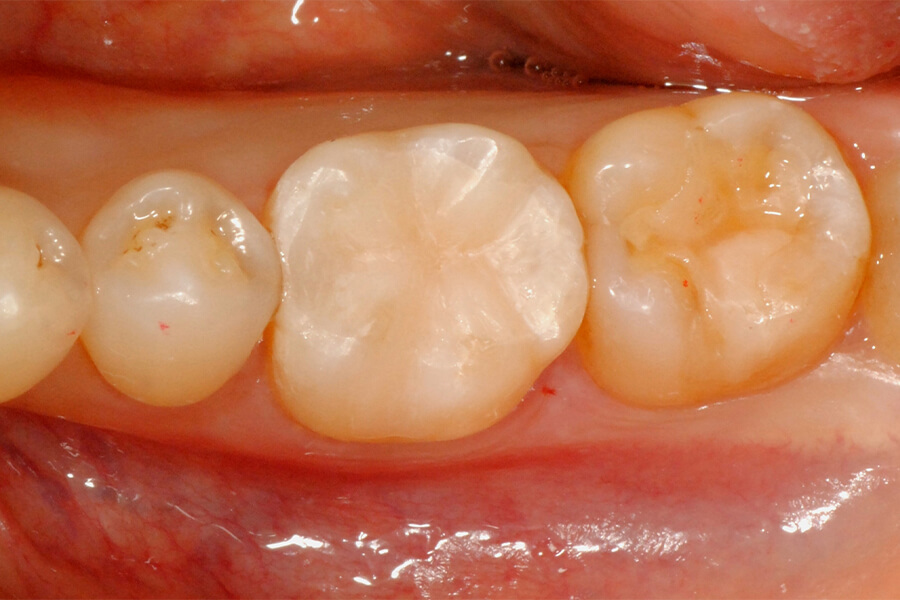 臼歯部インレーの再修復