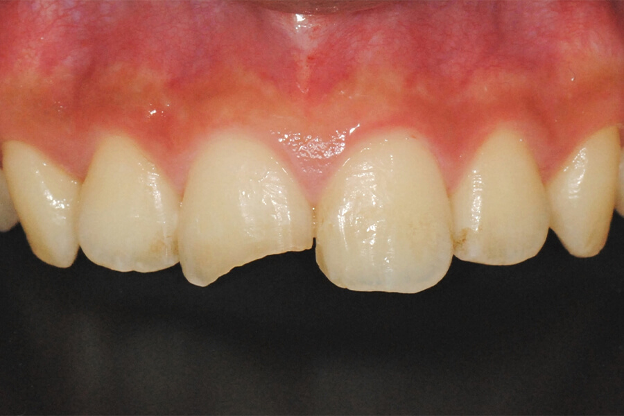 外傷による歯牙破折の修復