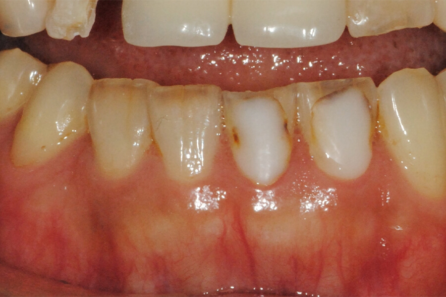 下顎前歯の咬耗の修復