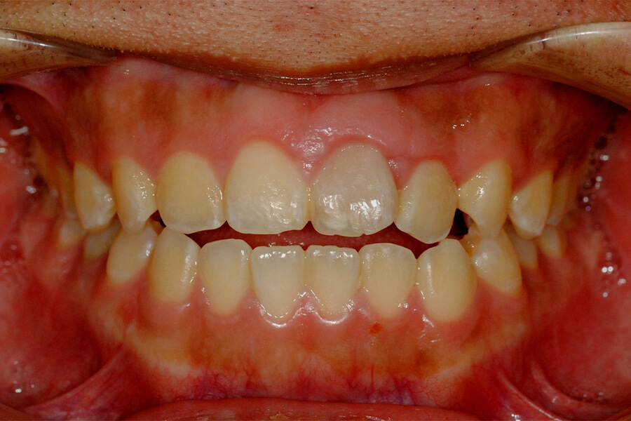 外傷歯の失活変色に対しての歯内法ホワイトニング＋KPCR＋ファイバーポスト補強