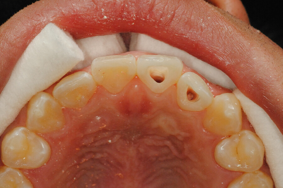 外傷歯の失活変色に対しての歯内法ホワイトニング＋KPCR＋ファイバーポスト補強