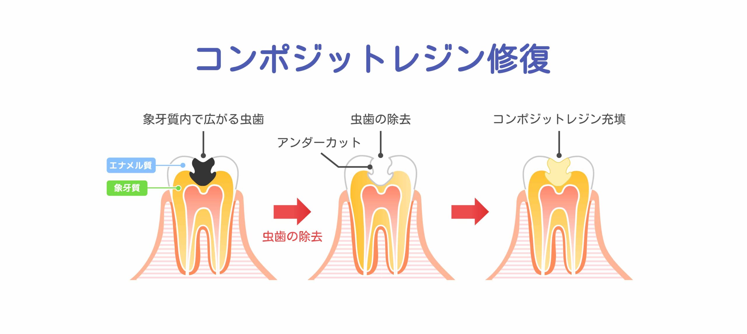 コンポジットレジン修復 ｜ ワイエスデンタルクリニック 鷹の台 国分寺小平 予防歯科・小児歯科・歯科医院