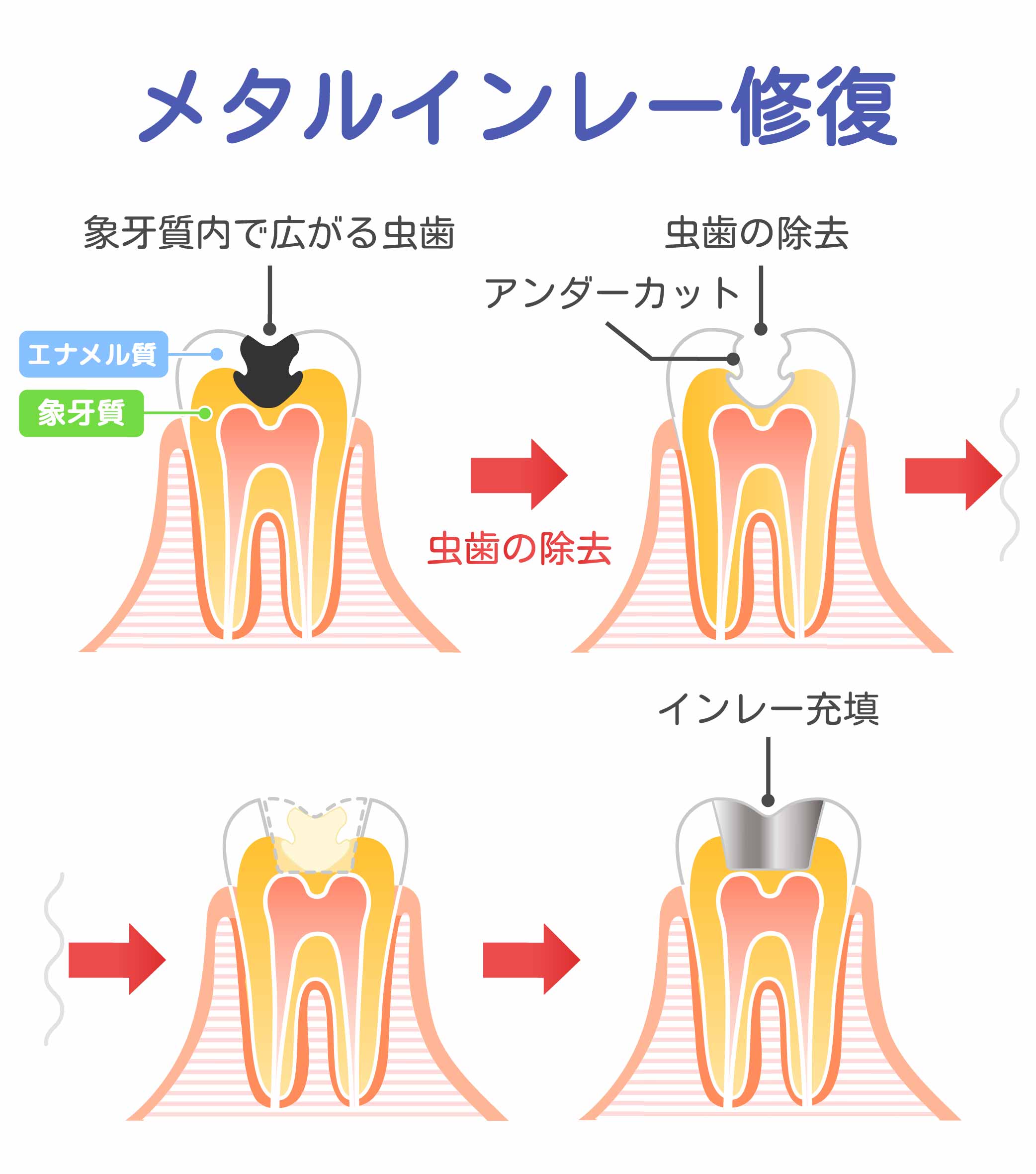 メタルインレー修復