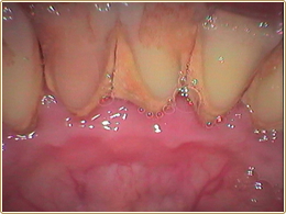 歯石が埋まっている歯歯間が埋まるほどの歯石、前歯の裏側は特にブラシをうまく当てにくい場所です。