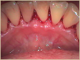 歯石、除去後の歯歯石を取り除くと歯ぐきが赤く充血しています。