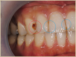 赤い丸部分の虫歯