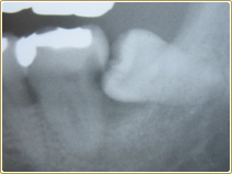 親知らずの抜歯