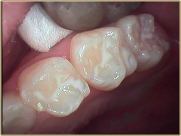 混合歯列期