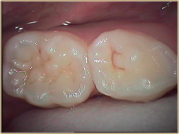 初期虫歯