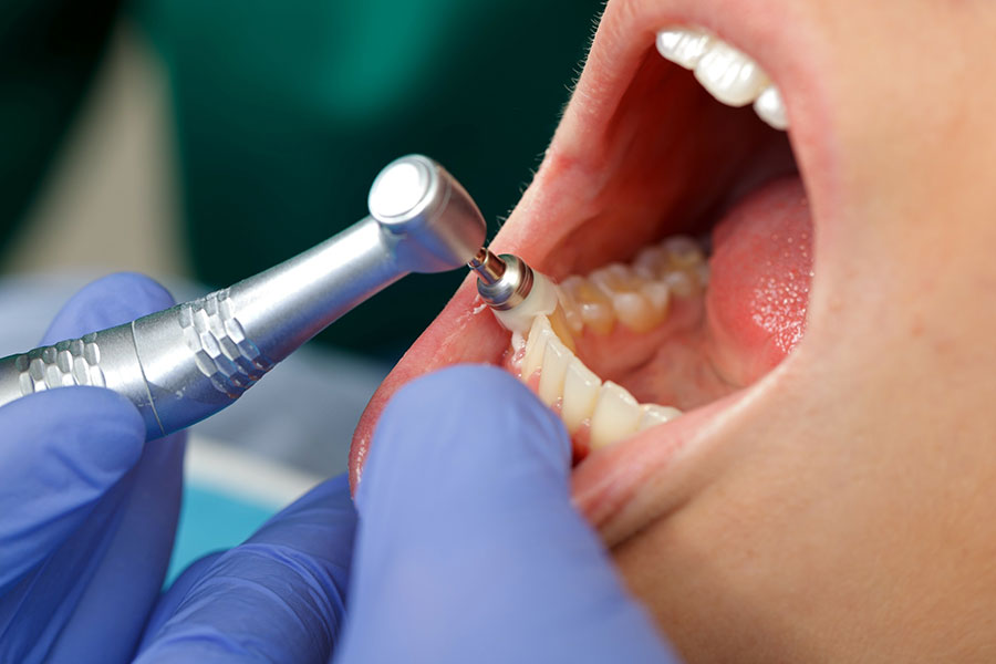 歯のクリーニング(PMTC)