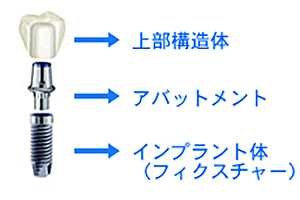 インプラントの構造