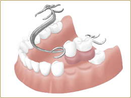 部分入れ歯